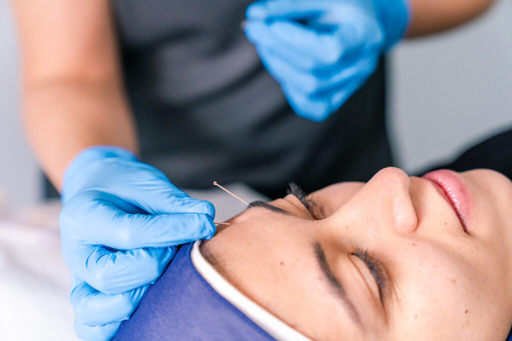 accupuncture